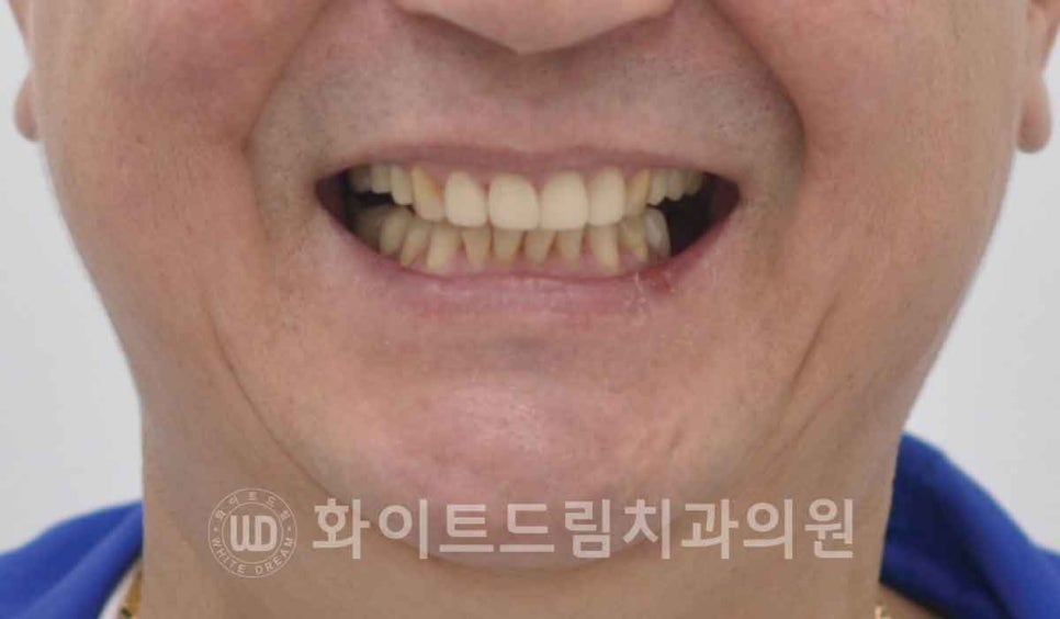 신논현역 당일 라미네이트, "길이가 다른 깨진 앞니" 당일 앞니 라미네이트 치료 과정은? 관련 이미지 3