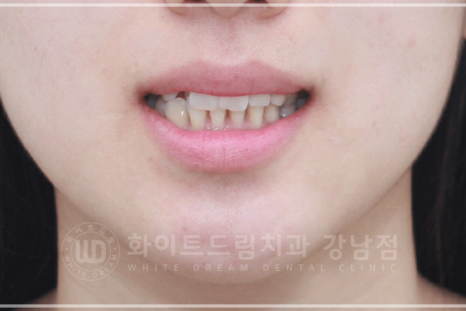 강남 덧니 비발치교정 / 임플란트와 치아교정 동시 진행 case 리뷰. 관련 이미지 28