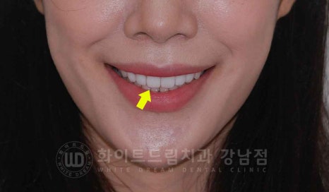 강남역 나비앞니 라미네이트 / "투명교정과 라미네이트 치료" 강남역 화이트드림치과 관련 이미지 4