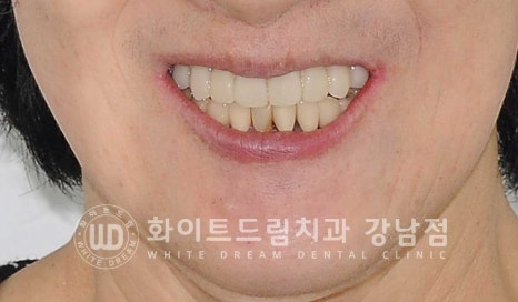 상악 풀케이스임플란트 사례 "부산에서 강남까지 왔어요" 관련 이미지 5