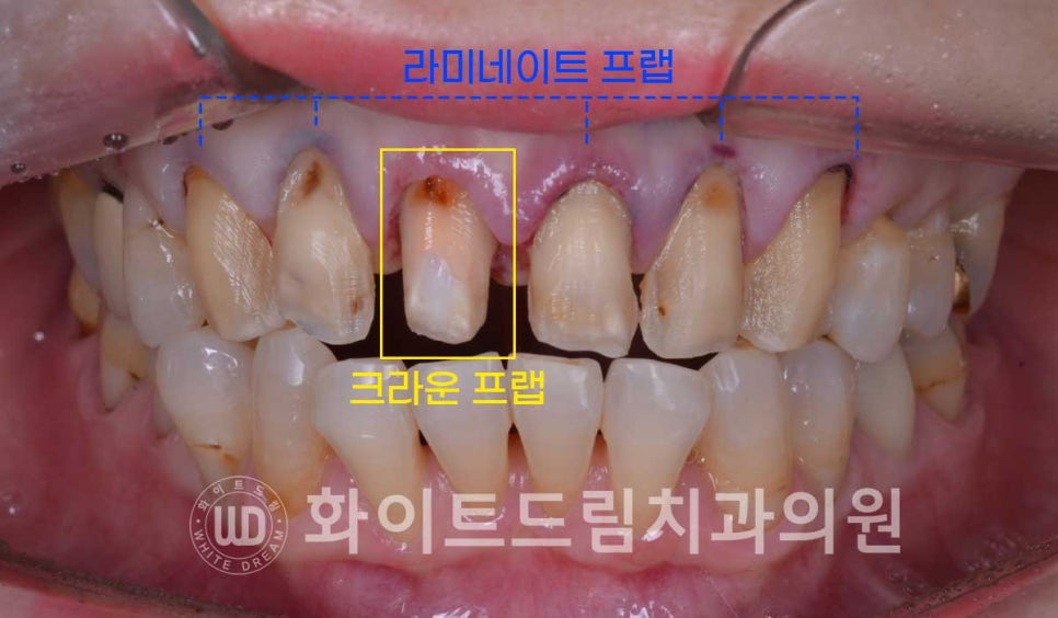 신논현라미네이트, 중년 충치치료, "치경부 우식증, 라미네이트로 당일 치료 OK" 관련 이미지 10