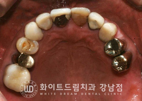 임플란트 개수를 줄일 수 있는 방법? (+치아를 발치한지 오래되었나요?) 관련 이미지 6