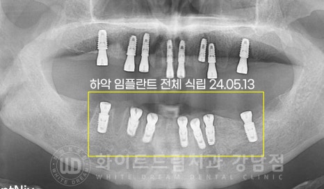 전체 임플란트 치료 기간과 내원 횟수는? "치과에 자주 가기 어려워요." 관련 이미지 17