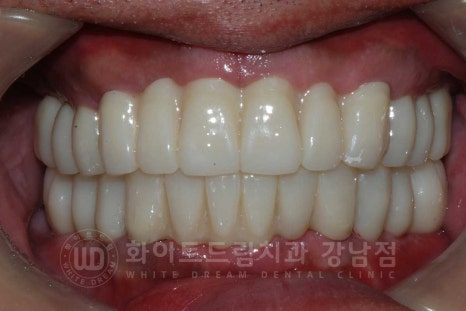 상악동거상술 잘하는치과, 강남역 화이트드림치과 상악동 함기화로 인한 거상술 치료 리뷰 관련 이미지 13