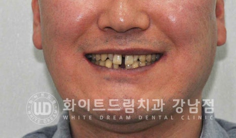 강남역 결손치 "앞니 두 개가 없고, 벌어졌어요" 결손치 치료 방법 관련 이미지 13