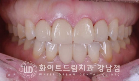 벌어진 앞니 라미네이트 / 50대 시니어 라미네이트 치료 사례 관련 이미지 3