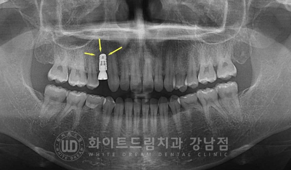 영구치 결손, "유치가 흔들려요." 성인 잔존 유치 발치 후 바로 임플란트 식립! 관련 이미지 7