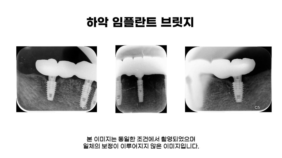 어금니임플란트 수복 및 당뇨환자임플란트 가격, 종류, 통증 관련 이미지 17