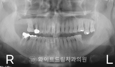 강남역치과 임플란트 "발치 후 바로 임플란트가 가능한 경우 vs 기다려야 하는 경우" 관련 이미지 10