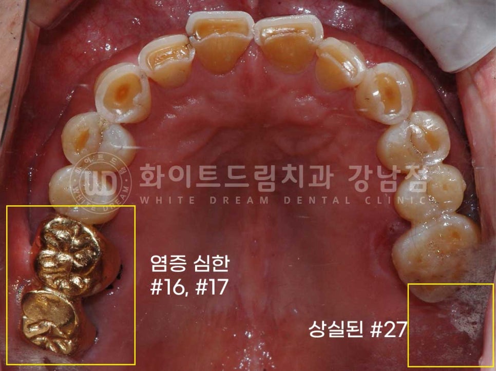 [흔들리는 어금니크라운] 흔들리고 냄새나는 오래된 크라운, 원인은? 관련 이미지 2