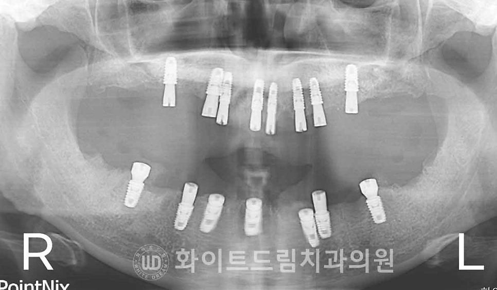 서울전체임플란트 / "경상도에서 왔어요." 치주염으로 인한 앞니 돌출 치료 (+서울전체임플란트 내원 횟수는?) 관련 이미지 12