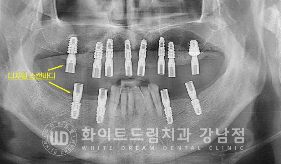 상악 풀케이스임플란트 사례 / "지인 추천으로 인천에서 왔어요." 관련 이미지 13