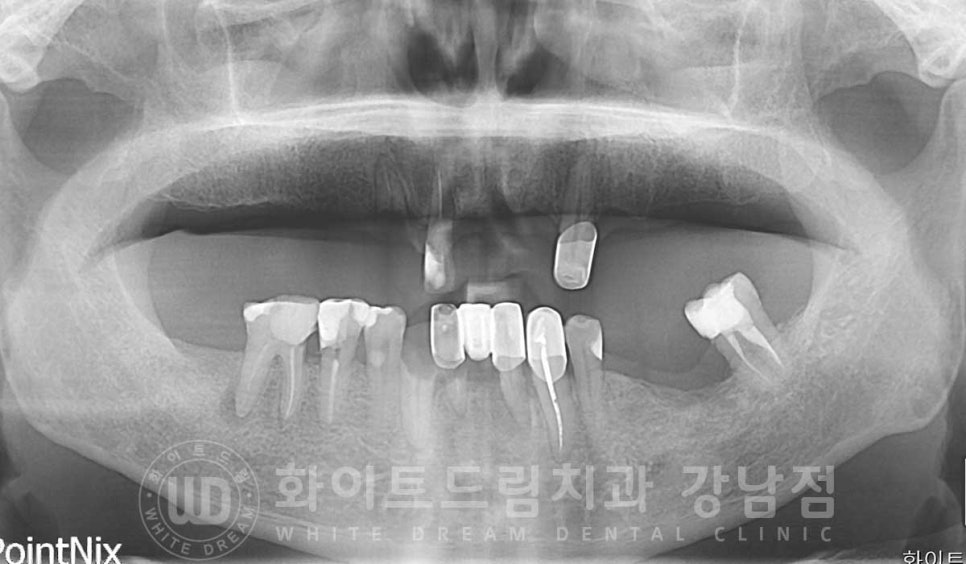 전체 임플란트 치료 기간과 내원 횟수는? "치과에 자주 가기 어려워요." 관련 이미지 9