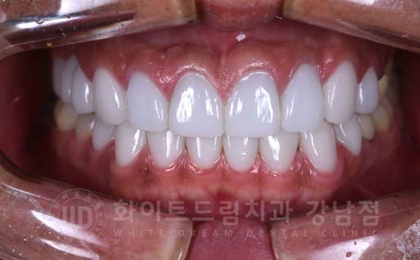 역삼역 앞니 치료  "예전에 한 크라운, 라미네이트 바꾸고 싶어요" 라미네이트 & 크라운 재치료 관련 이미지 10