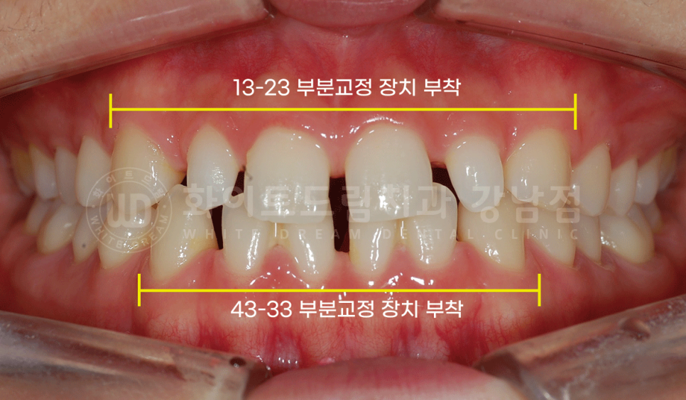 강남 벌어진앞니 교정 / "심하게 벌어진 치아, 어떻게?" 부분교정 + 라미네이트로 개선! 관련 이미지 7