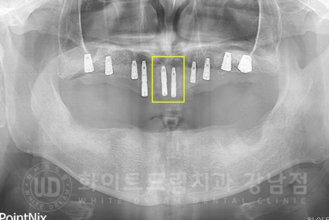 강남역 전체임플란트 치과 "치아가 심하게 흔들려요." 심한 치주염 임플란트 치료 관련 이미지 12