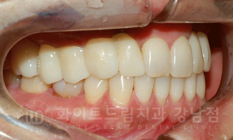 강남역 치과브릿지 "브릿지가 흔들려요" 흔들리는 브릿지 치료는? 관련 이미지 15