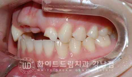 앞니 빠짐 임플란트 / 사고로 인한 앞니 탈구. 앞니 임플란트 치료는? 관련 이미지 13