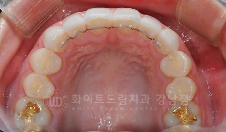 강남역 나비앞니 라미네이트 / "투명교정과 라미네이트 치료" 강남역 화이트드림치과 관련 이미지 18