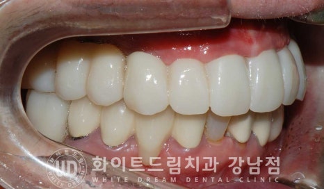 상악 풀케이스임플란트 사례 "부산에서 강남까지 왔어요" 관련 이미지 17