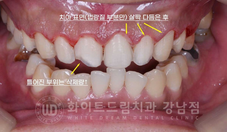 틀어진 치아 라미네이트, 틀어지고 색이 다른 앞니가 고민이에요. 관련 이미지 10