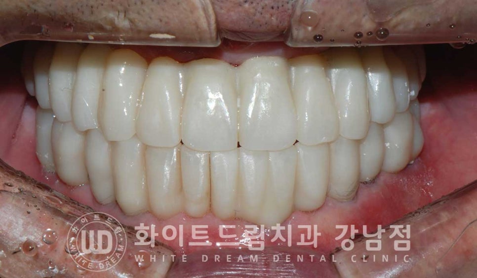 전체 임플란트 치료 기간과 수술 후 나타나는 변화는? 관련 이미지 11