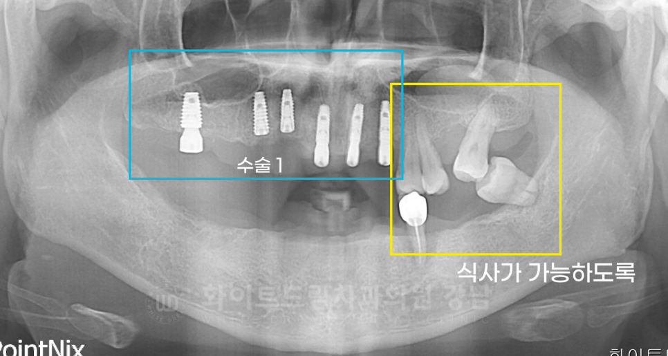 강남역 임플란트 치과 "틀니가 안 맞아서 불편해요" 틀니 → 전체 임플란트로! 관련 이미지 11
