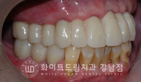 상악 풀케이스임플란트 사례 / "지인 추천으로 인천에서 왔어요." 관련 이미지 17
