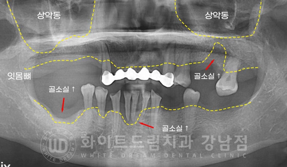 치주염 전체임플란트 치료 사례 / 치아를 흔들리게 만드는 치주염이란? 관련 이미지 9