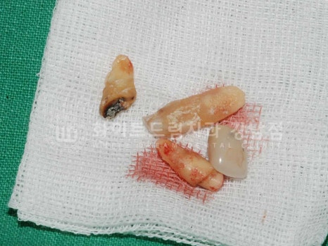 잇몸뼈가 없다는 게 무슨 말일까? "틀니를 오래 사용해서 잇몸뼈가 없대요" 임플란트 잘하는 강남치과 관련 이미지 9