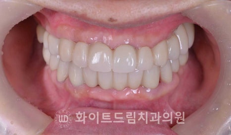 강남역전체임플란트 / 발치 후 즉시 식립, 무조건 누구나 3개월로 끝낼 수 있는 것일까? 강남역화이트드림치과 관련 이미지 4