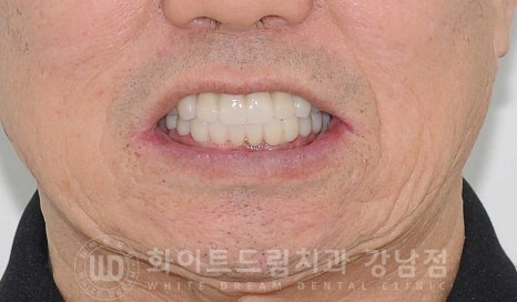 전체 임플란트 치료 기간과 내원 횟수는? "치과에 자주 가기 어려워요." 관련 이미지 3