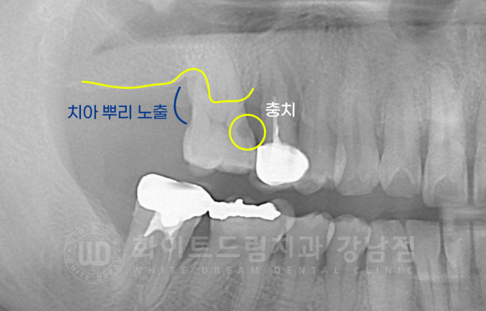 서초동 어금니 임플란트 / 강남역 화이트드림치과 : 상악동 거상술 (crestal approch) 관련 이미지 3