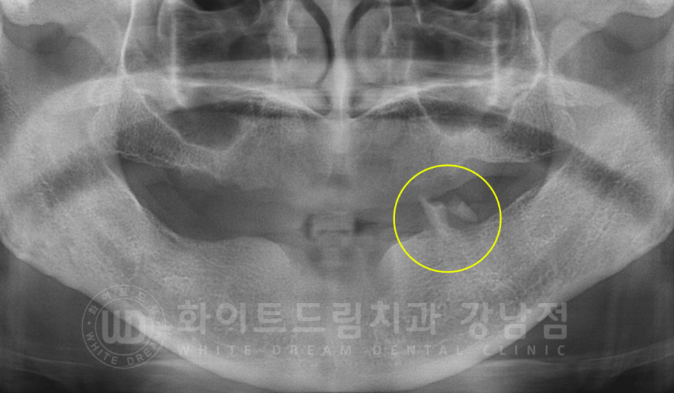 서울 전체임플란트 기간 / 전체 임플란트 7개월 완성, 무치악 임플란트 관련 이미지 5