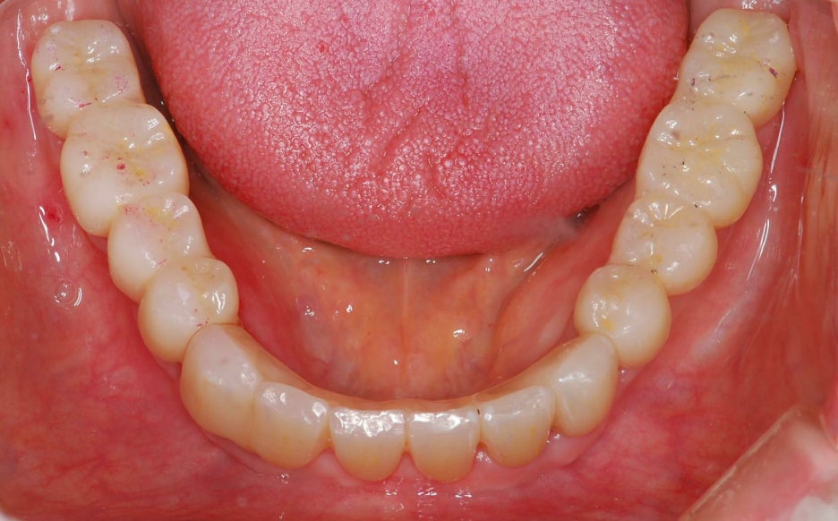 임플란트 하기 전 알아보아야 할 것. 관련 이미지 19