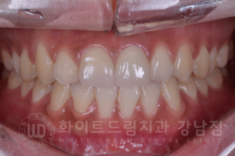 강남역 주변 치과 "10년 된 앞니가 변색됐어요" 앞니 심미 치료 관련 이미지 15
