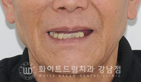 상악 풀케이스임플란트 사례 / "지인 추천으로 인천에서 왔어요." 관련 이미지 2