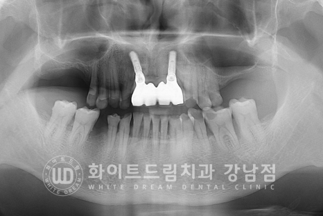 강남역 임플란트치과 / "어금니가 없고 이갈이가 심해요" 강남역 화이트드림치과 관련 이미지 11
