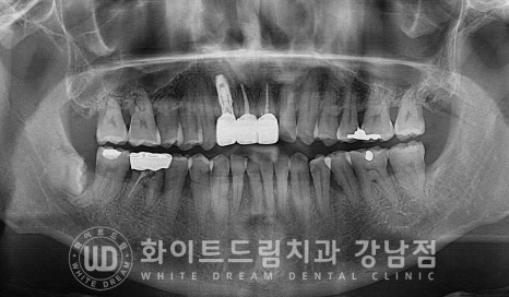 사고당한 앞니치료, "흔들리고 점점 변색돼요." 앞니 임플란트 & 신경치료 관련 이미지 15