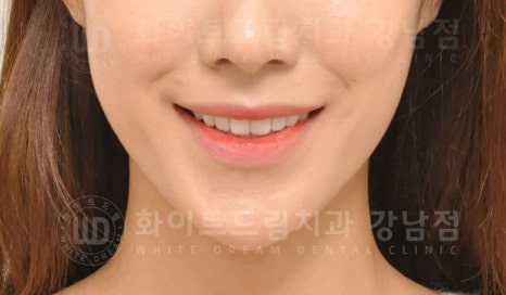 강남역 나비앞니 라미네이트 / "투명교정과 라미네이트 치료" 강남역 화이트드림치과 관련 이미지 20