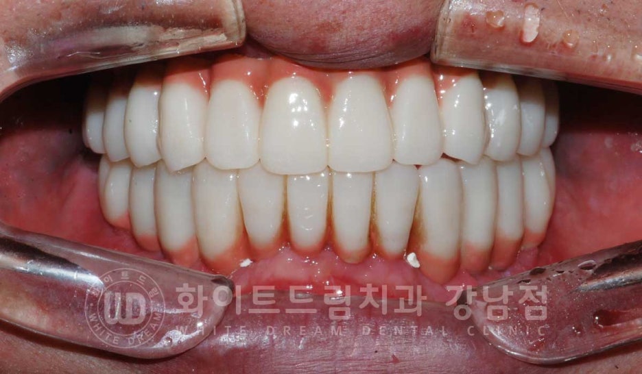 Gangnam Station Dental Clinic Specializing in Implant Revision Surgery—Revision Surgery and Full-Mouth Implant Treatment at the Same Time! image 9