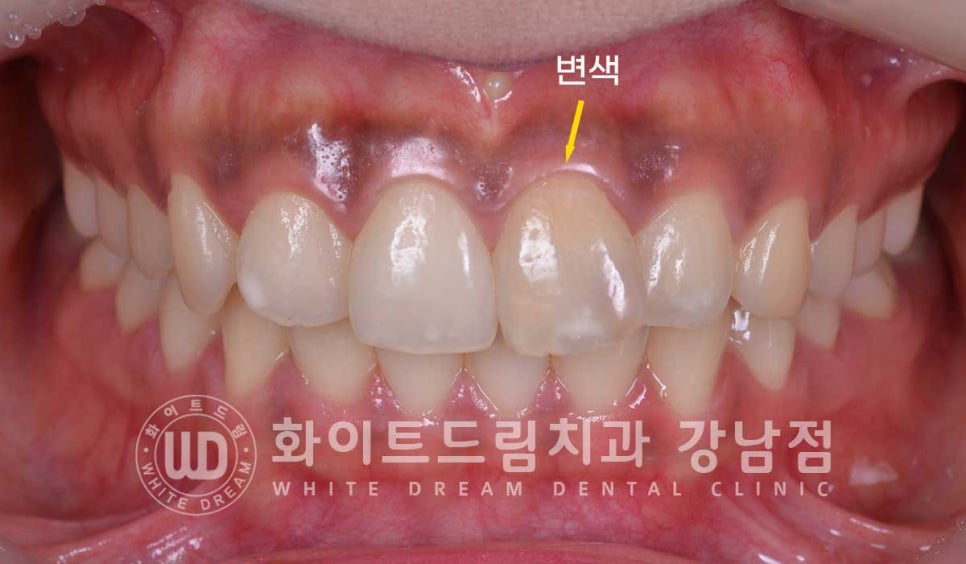 신경치료 후 변색된치아, 라미네이트로 변색과 모양까지 개선! / 강남역화이트드림치과 관련 이미지 4