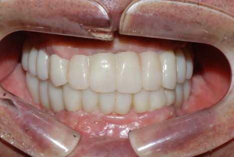 서울전체임플란트잘하는치과, 왜 치주염이 심해지면 반대교합까지 생길까요? (치주염 전체 임플란트 CASE) 관련 이미지 3