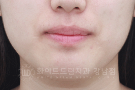 강남 덧니 비발치교정 / 임플란트와 치아교정 동시 진행 case 리뷰. 관련 이미지 4