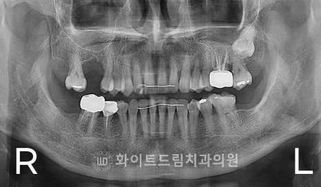 강남역어금니임플란트 치료 시 흔히 동반되는 상악동거상술 (Lateral window 방식), "잘 됐는지 어떻게 확인하죠?" 관련 이미지 12