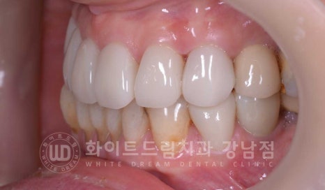 노화된 치아 라미네이트 / 치아미백을 해도 하얘지지 않는 마모된 치아는 어떻게 할까? 관련 이미지 16