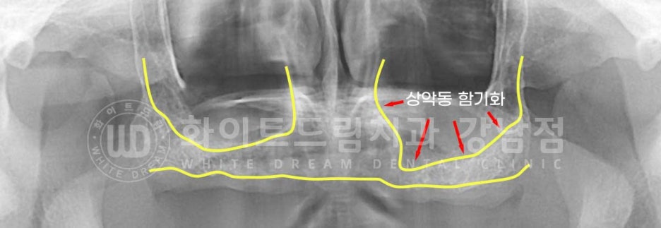 Gangnam Station Dental Clinic Specializing in Implant Revision Surgery—Revision Surgery and Full-Mouth Implant Treatment at the Same Time! image 4