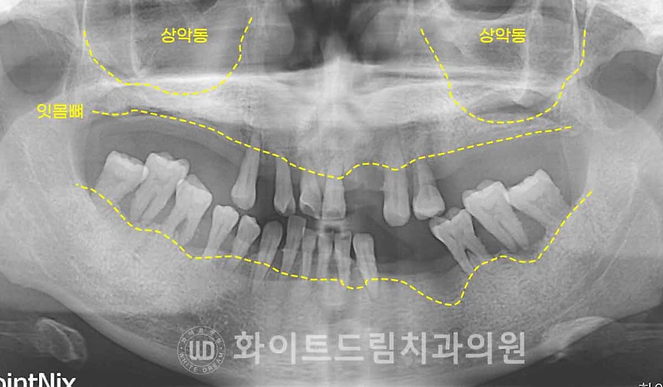 서울전체임플란트 / "경상도에서 왔어요." 치주염으로 인한 앞니 돌출 치료 (+서울전체임플란트 내원 횟수는?) 관련 이미지 7