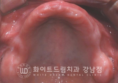 상악 풀케이스임플란트 사례 "부산에서 강남까지 왔어요" 관련 이미지 18