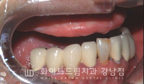 상악 풀케이스임플란트 사례 "부산에서 강남까지 왔어요" 관련 이미지 9